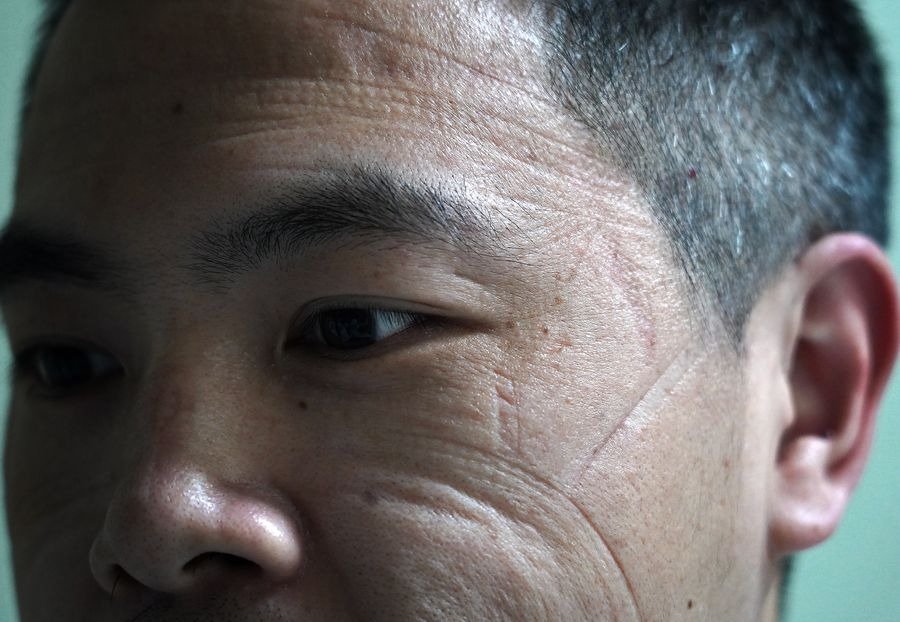 Health Hub 75 Close-up of man’s face showing deep sleep lines and facial wrinkles from pillow pressure
