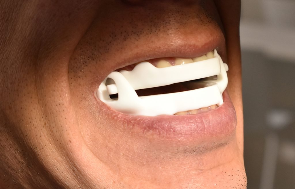 Health Hub 39 Close-up of man wearing dental mouth guard for sleep apnea and snoring treatment